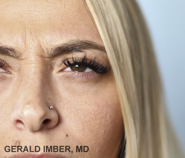 Botox Before and After