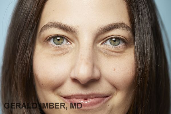 Tear Trough Augmentation with Fillers