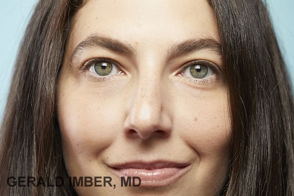 Tear Trough Augmentation with Fillers