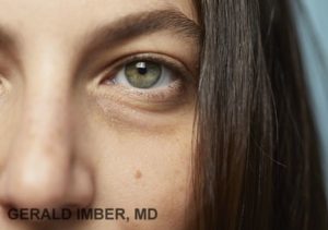 Tear Trough Augmentation with Filler