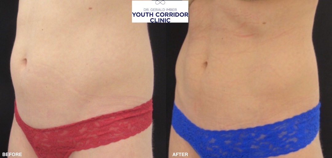 truSculpt® Flex Before & After