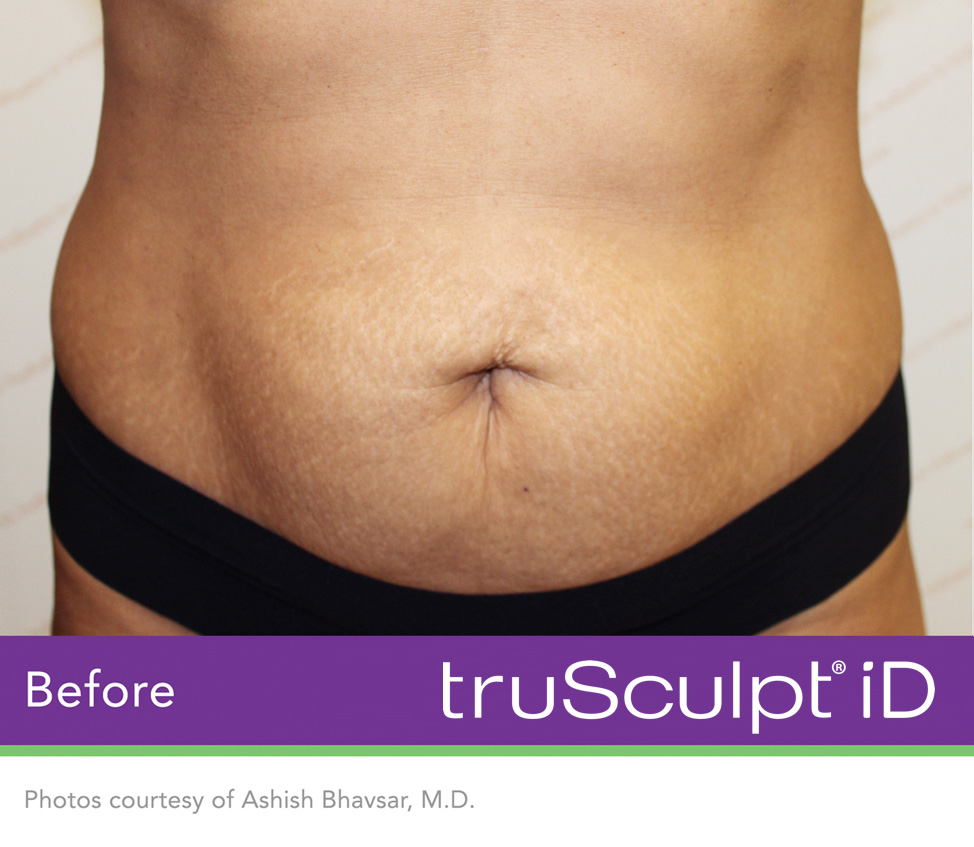 truSculpt® iD Before