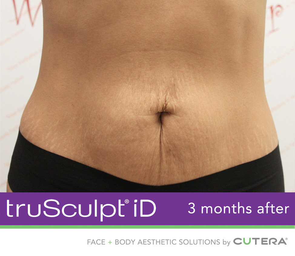 truSculpt® iD After