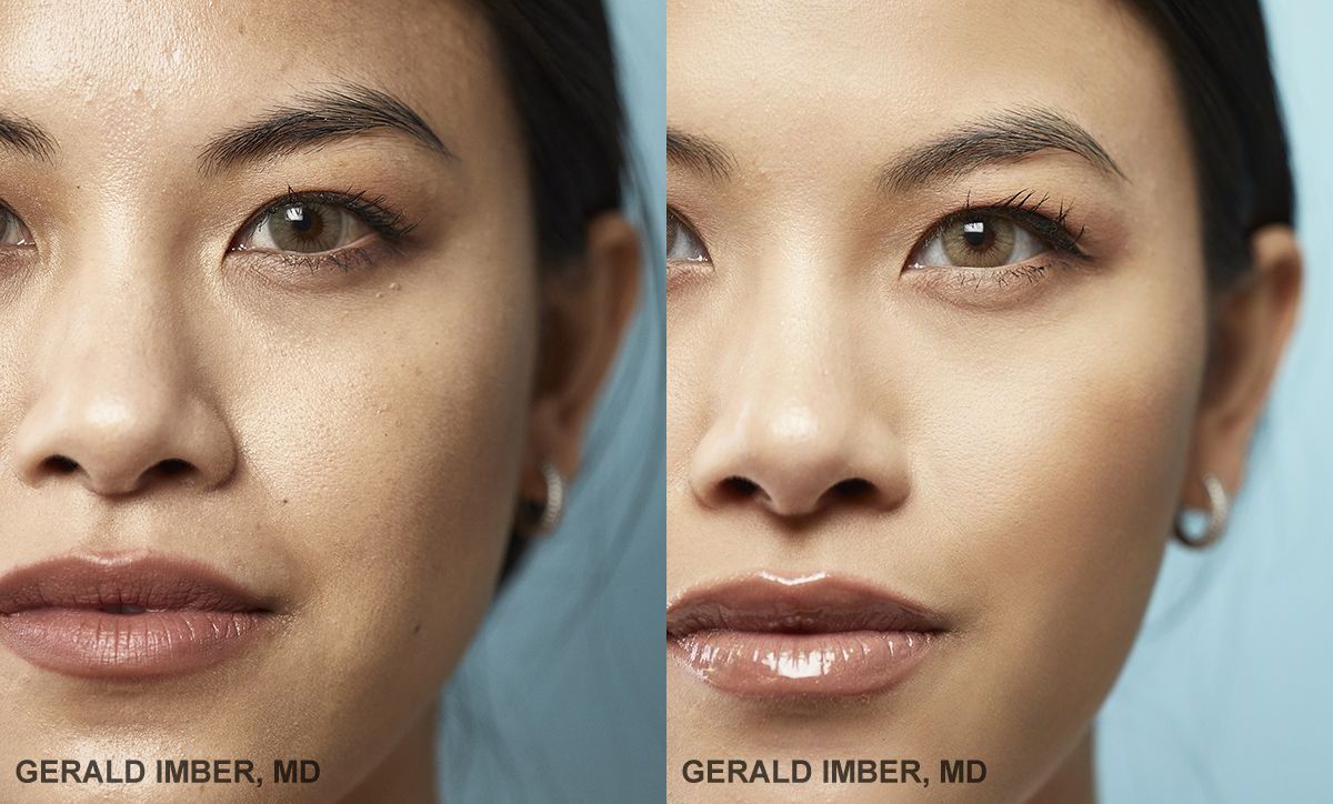 Cheek Augmentaion with Filler Before and After Photo by Dr. Imber in New York, NY