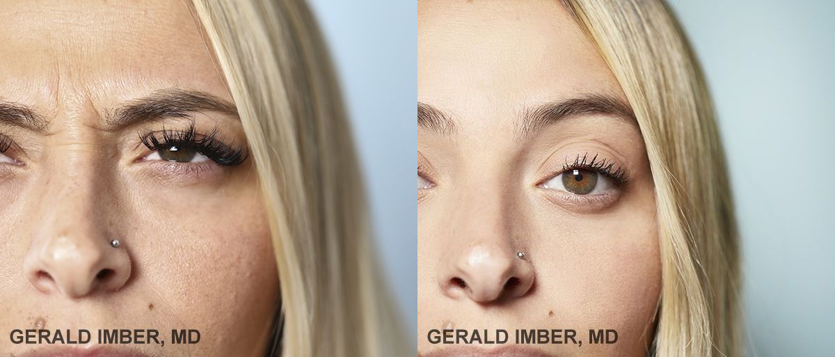 Botox Before and After Photo by Dr. Imber in New York, NY