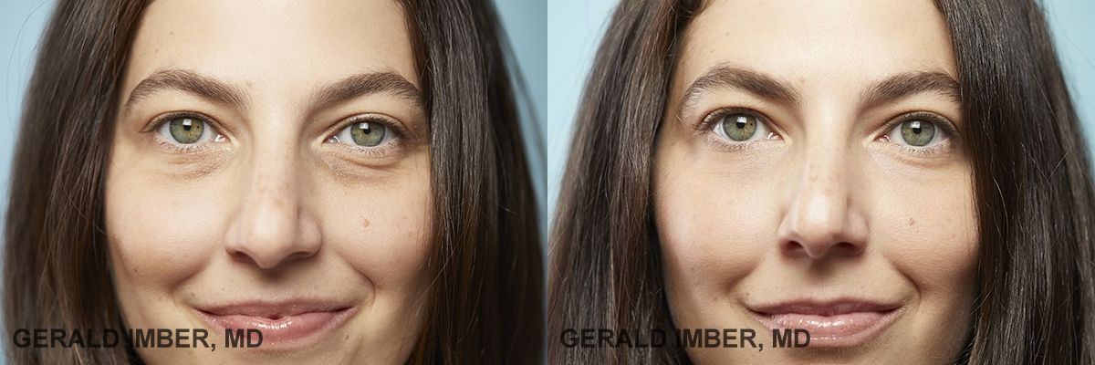 Tear Trough Augmentation with Filler Before and After Photo by Dr. Imber in New York, NY