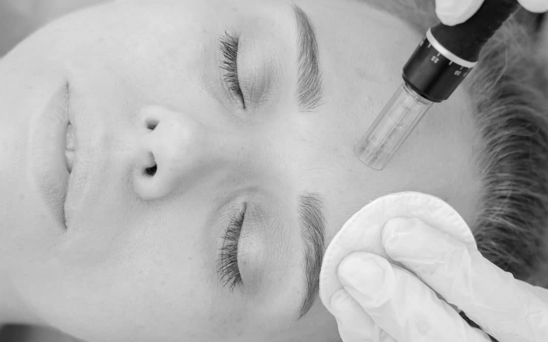 Top Reasons to Avoid at Home Microneedling