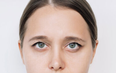 If your upper eyelids are droopy, consider this simple surgery!