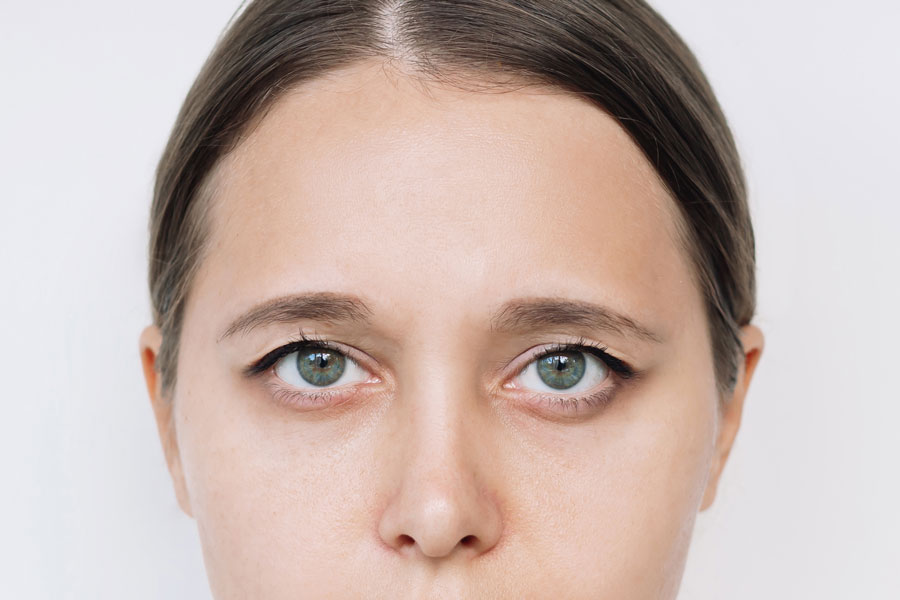 woman with droopy eyelids