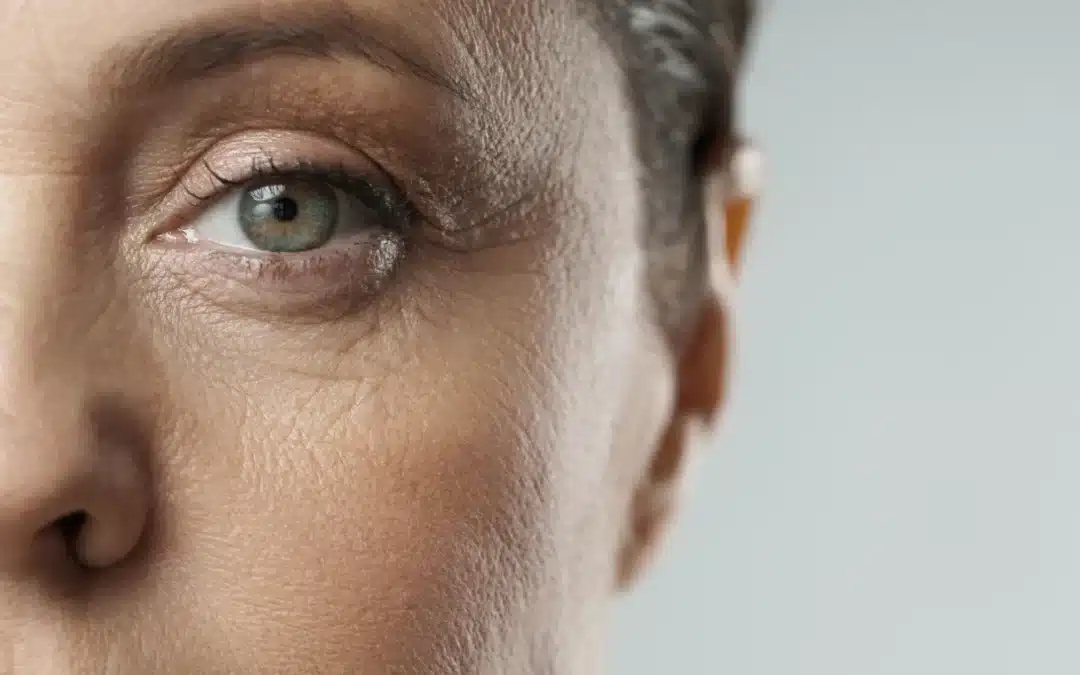 Are your under eye bags bothering you?