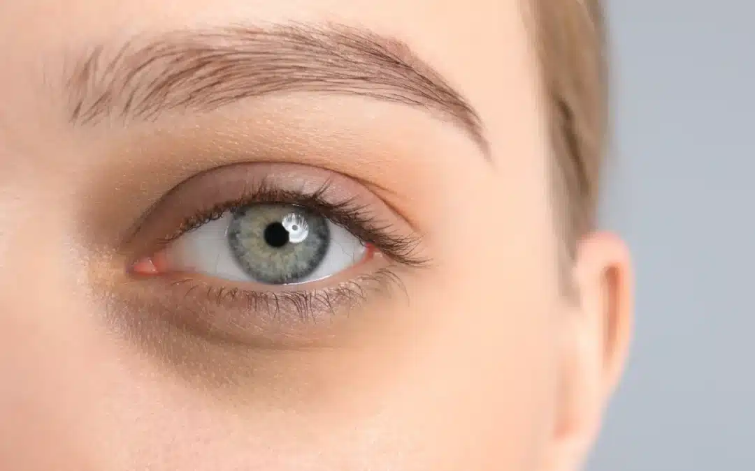 How To Correct Dark Circles Under Eyes