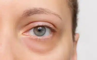 Recovery Tips for Tear Trough Augmentation